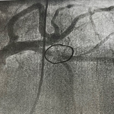 Richard's artery blockage