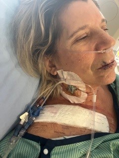 Woman lying in a hospital bed with an oxygen tube and medical lines